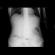 Volvulus, torsion of ileum, ileus: X-ray - Plain radiograph